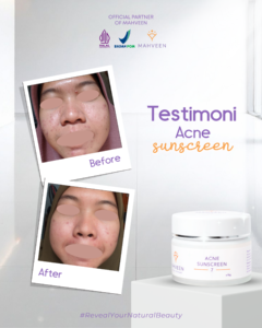 Slide 4 Acne Sunscreen